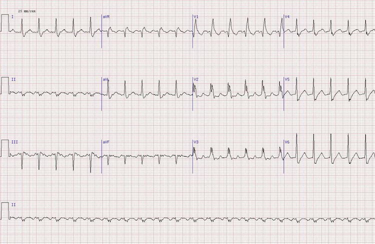 нижний Q-инфаркт миокарда неопределенной давности