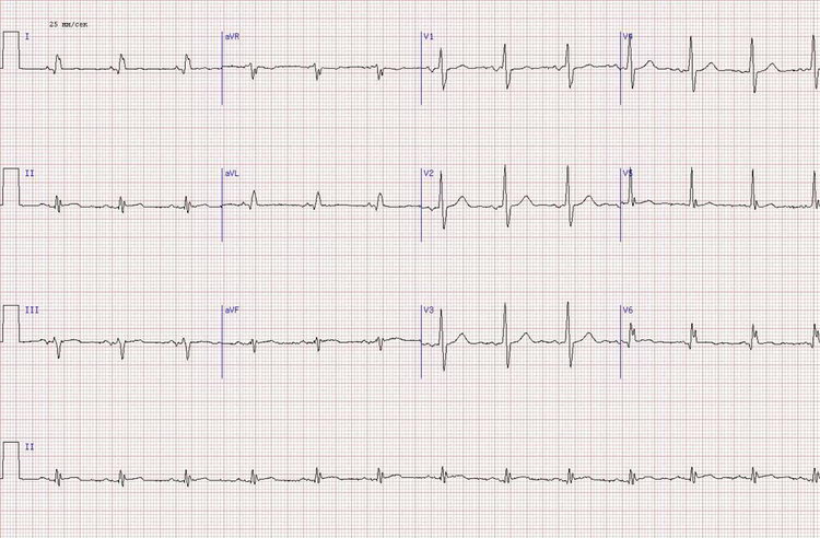 R в V1-V2 из-за бокового инфаркта миокарда