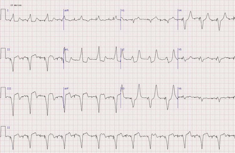 Острый инфаркт миокарда задне-диафрагмальной области