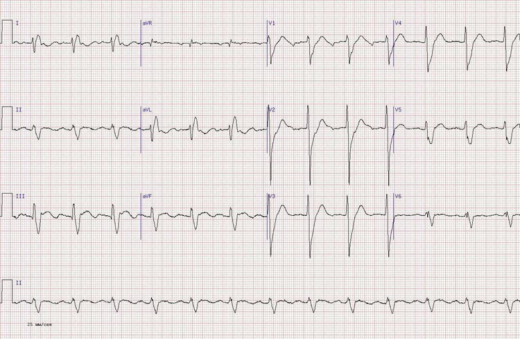 нижний Q-инфаркт миокарда неопределенной давности