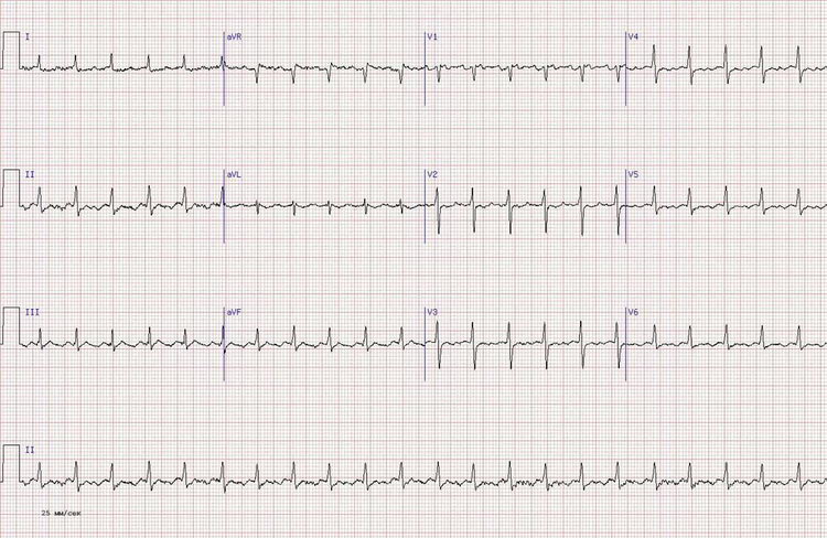 R в V1-V2 из-за бокового инфаркта миокарда